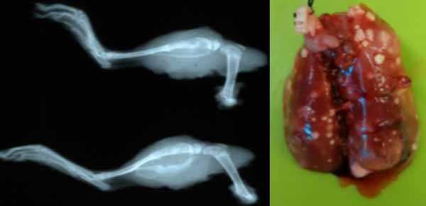 Osteosarcoma